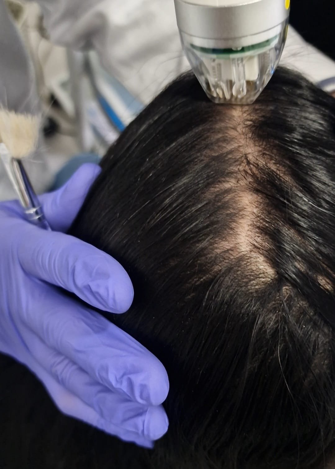 Hair Loss Treatments